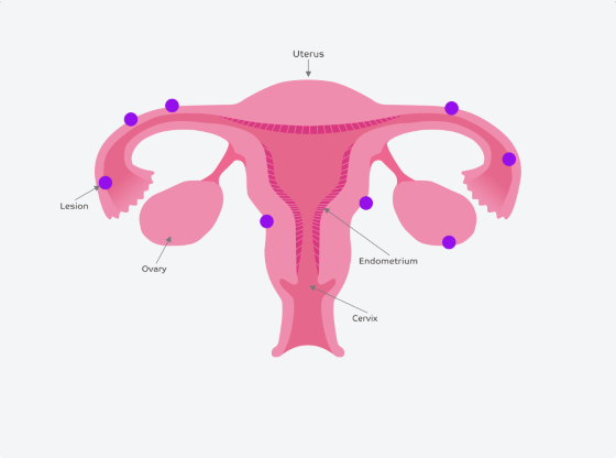 Endometrióza se může nacházet prakticky na jakémkoliv místě v těle a dále se přemisťovat, nicméně nejběžněji se objevuje na vaječnících, vejcovodech či děloze (viz. fialové body)